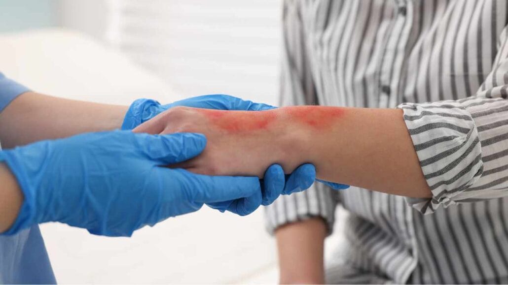 Profissional de saúde com luvas examina o braço de uma pessoa com queimadura avermelhada na pele.